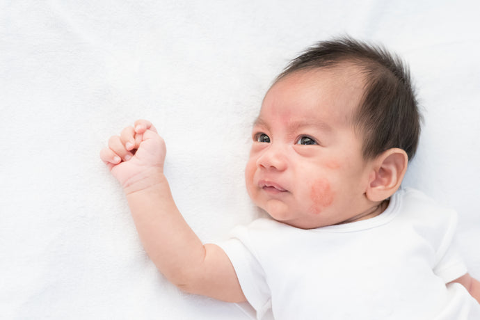 How to Stop your Baby Scratching their Eczema