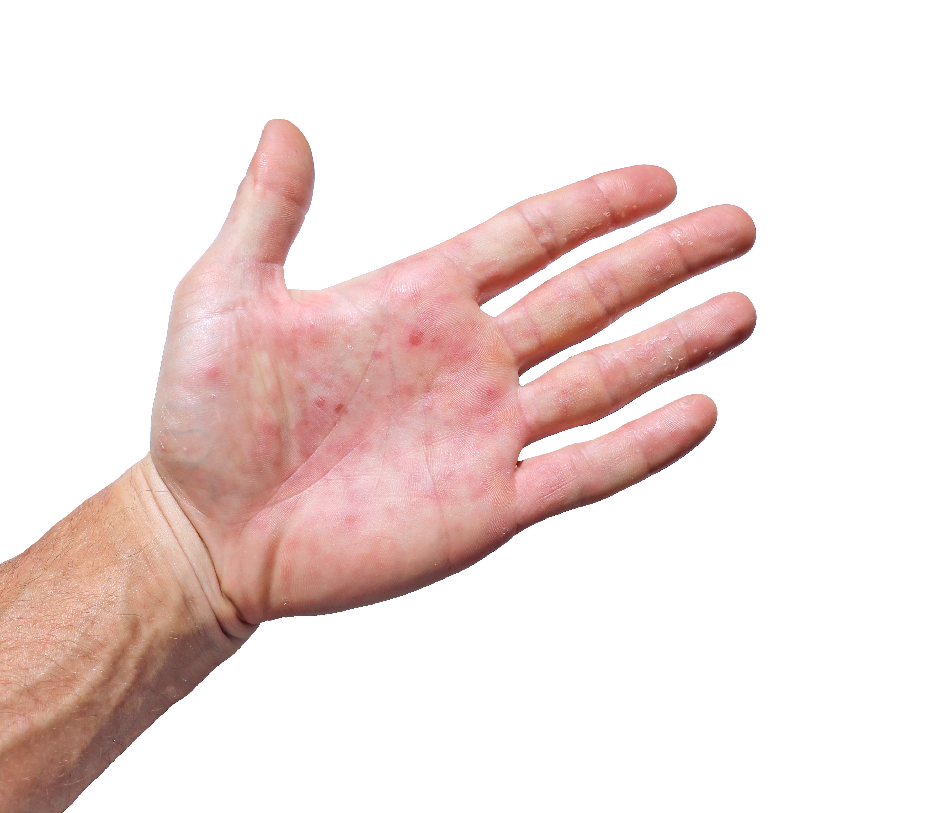 Decoding Dyshidrotic Eczema: Blisters, Triggers, and Triumphs!