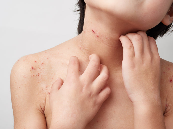 How to stop eczema itching?