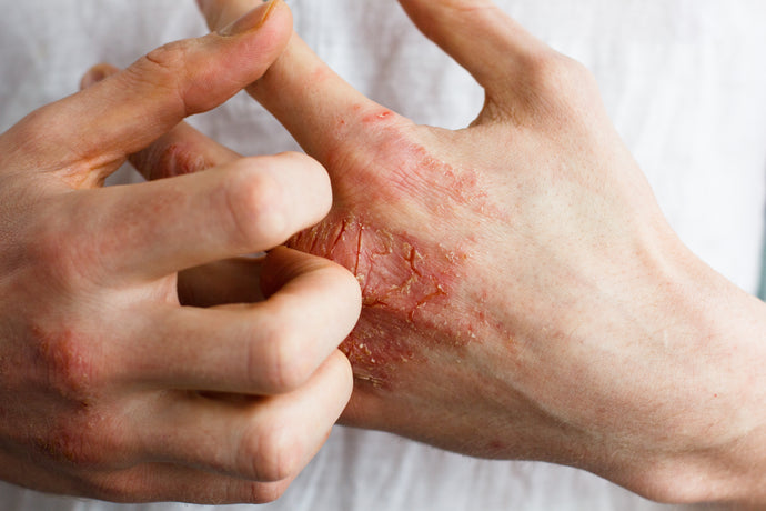 Why Eczema Itches